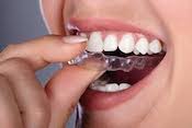 Invisalign clear aligners 2
