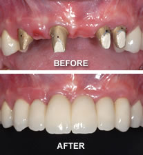 multiple dental implants
