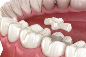safe-amalgam-removal-White-Fillings-in-Solihull-Birmingham