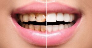 porcelain veneers before after