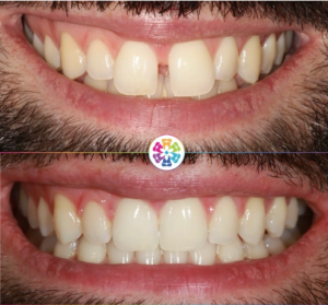 Before and After