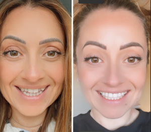 Before and After Invisalign Treatment
