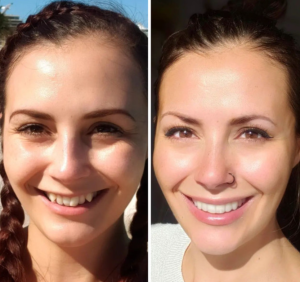 Before and After Invisalign Treatment In Solihull
