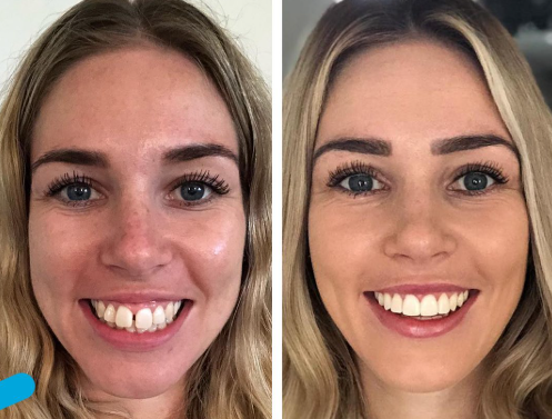 Before and After Invisalign Treatment at Eternal Smiles