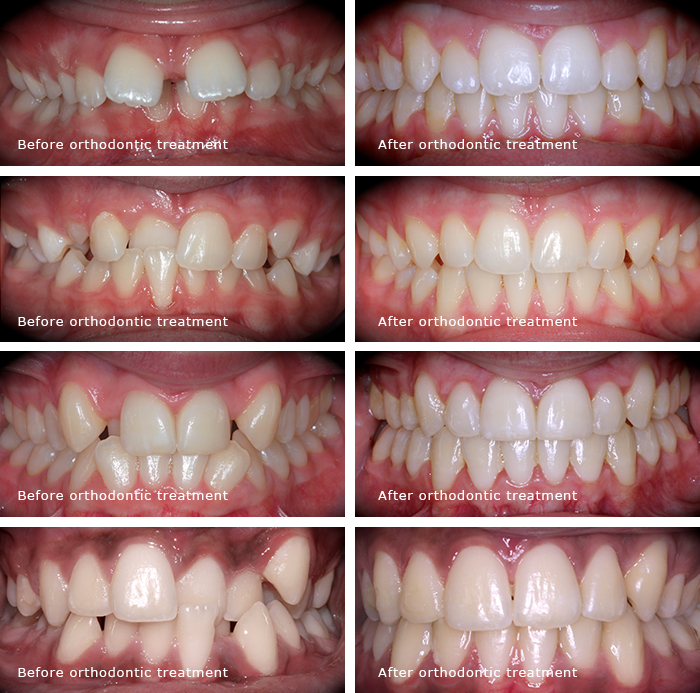 Invisalign before after copy