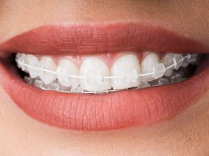 ceramic braces