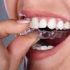 Invisalign-clear-aligners